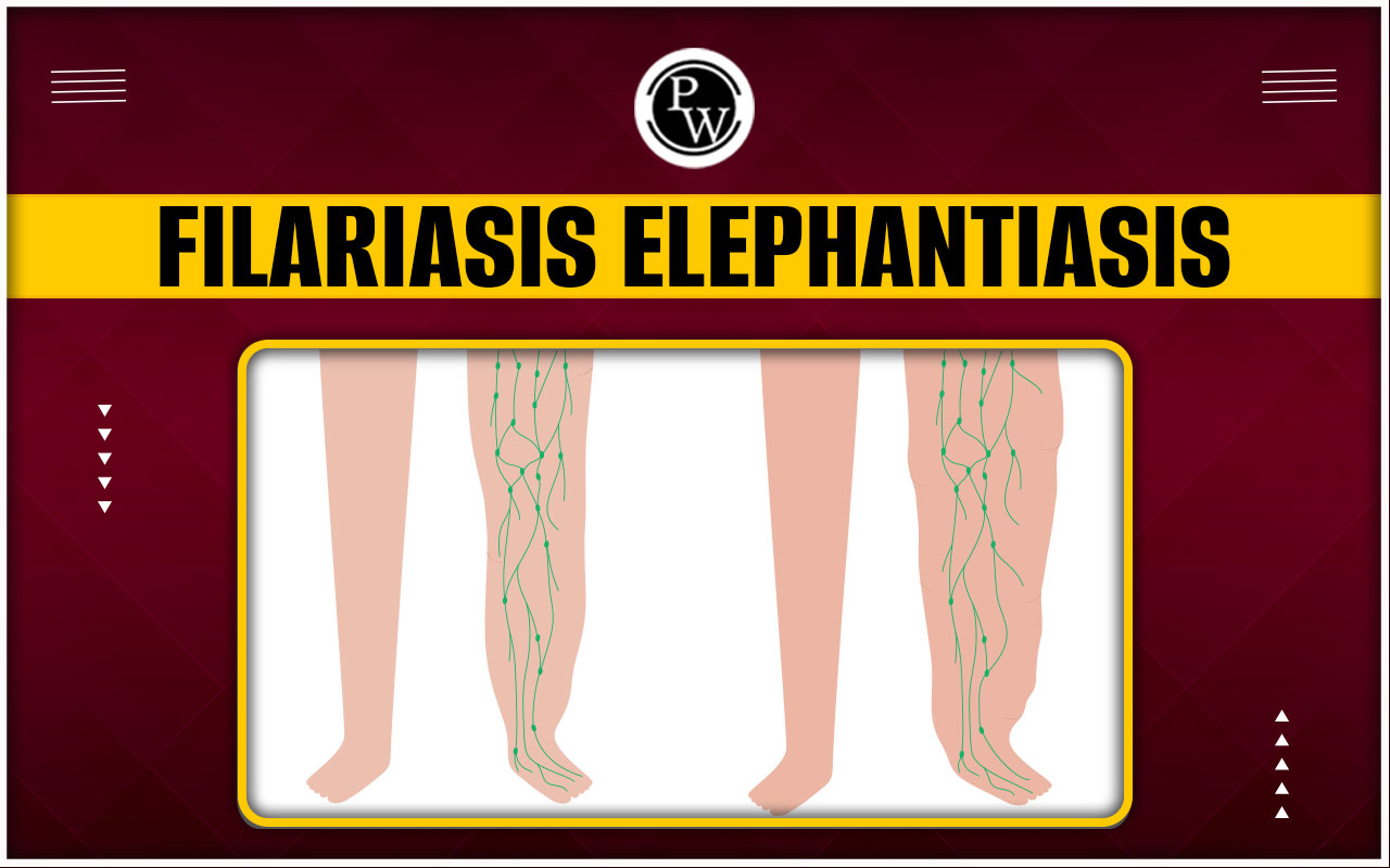 Filariasis Elephantiasis