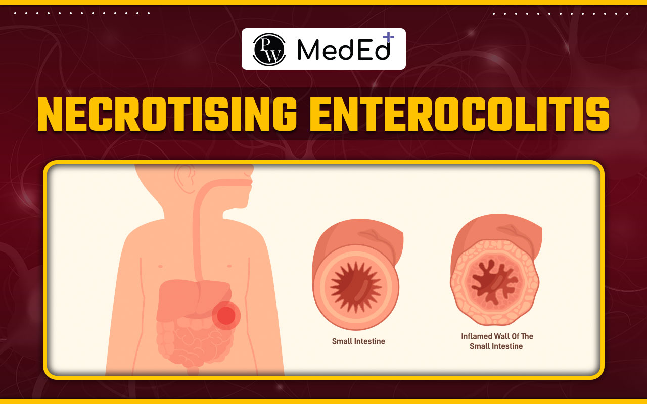 Necrotising Enterocolitis