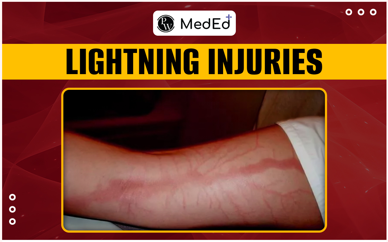 Lightning Injuries Causes, Symptoms, Diagnosis, And Treatment Process