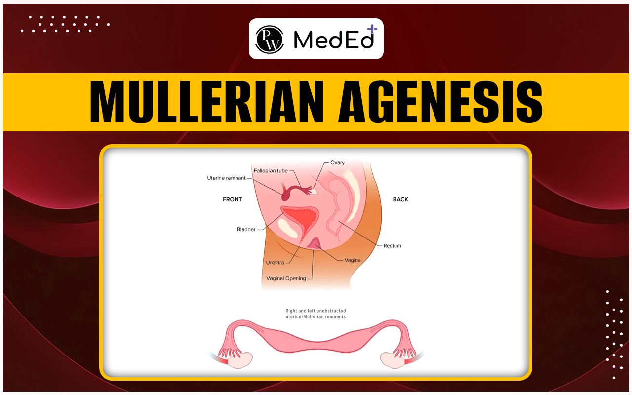 Mullerian Agenesis Causes, Symptoms, Complications, And Treatment