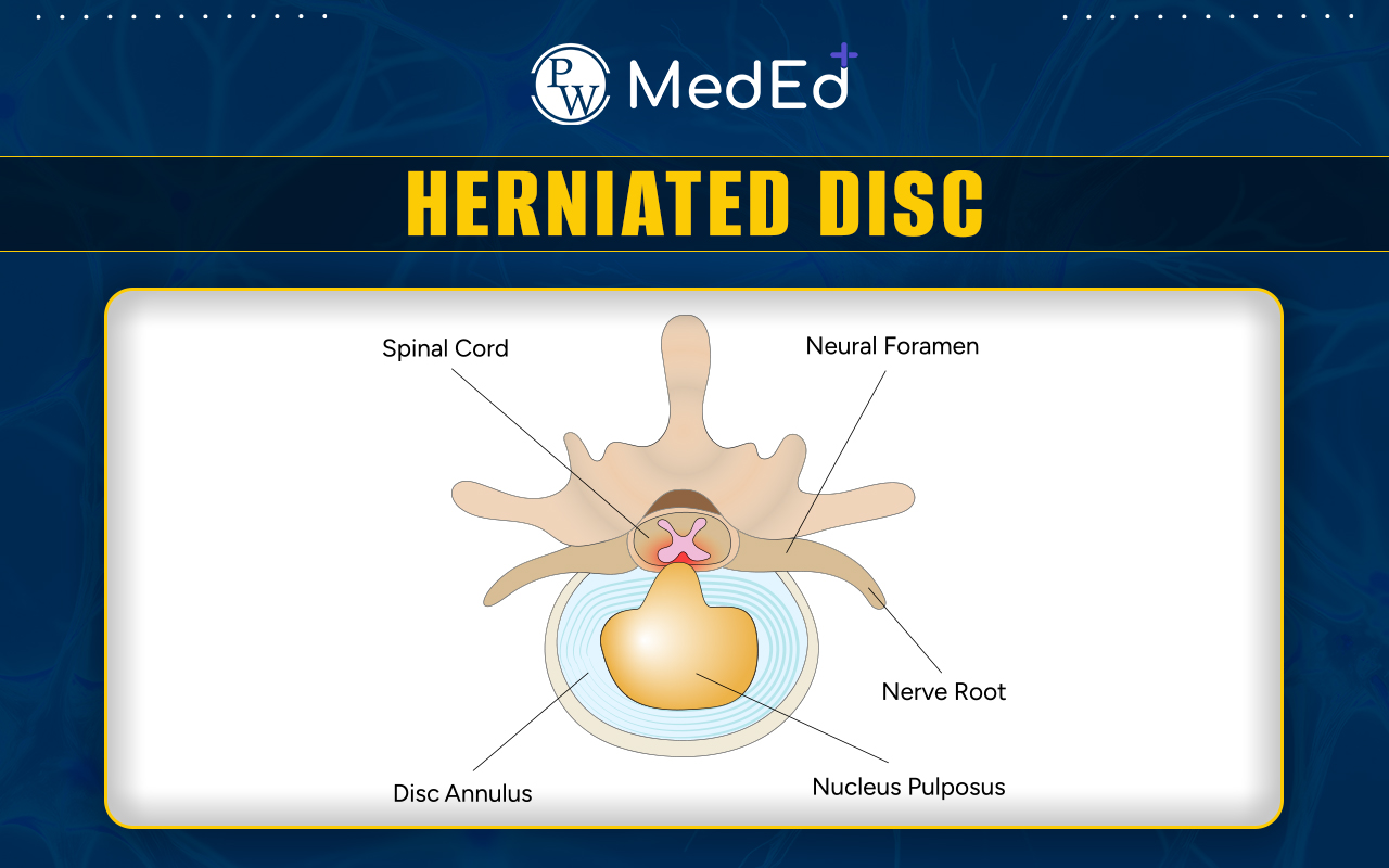 Herniated Disk