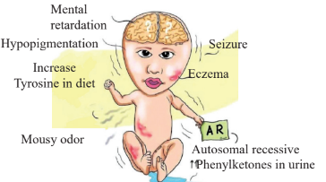 Symptoms of phenylketonuria