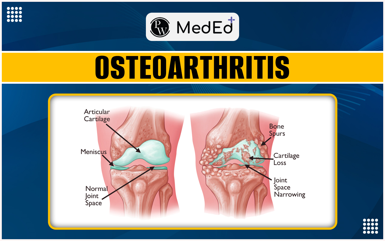 Osteoarthritis Types, Causes, Symptoms, Diagnosis