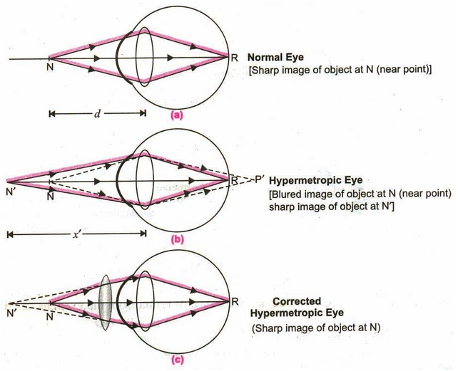 Defects Of Vision And Their Corrections