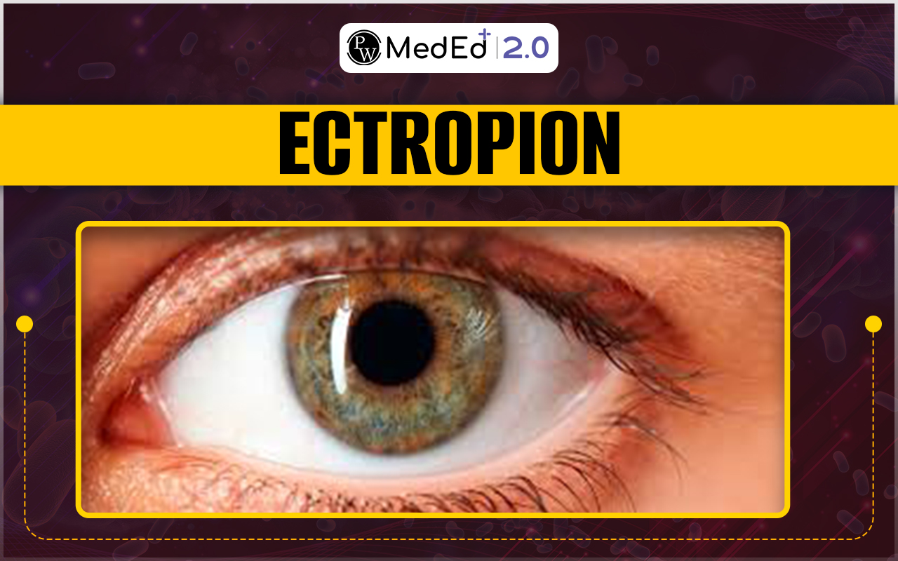Ectropion