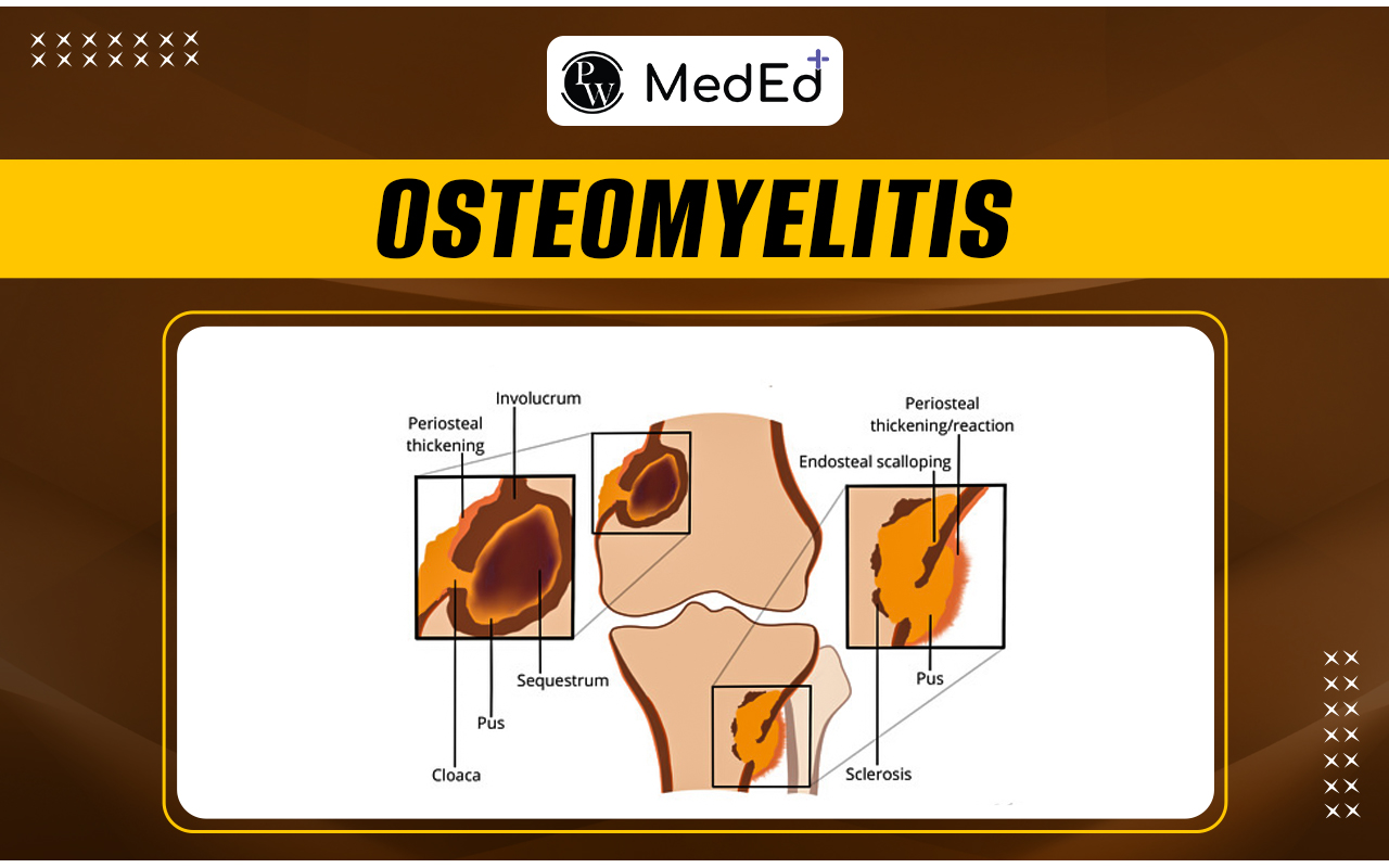 Osteomyelitis Causes, Symptoms, Diagnosis, And Treatment