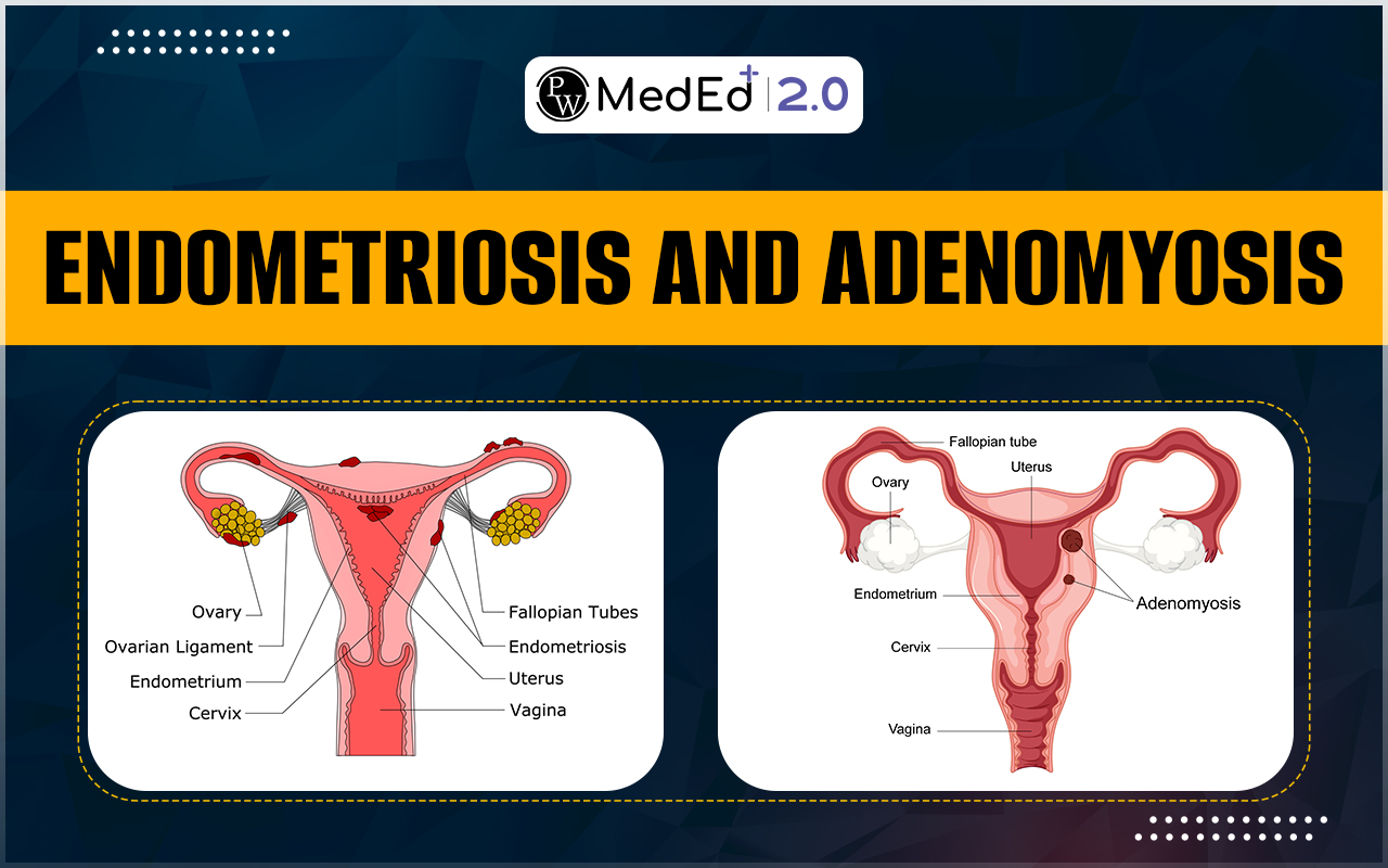 Endometriosis Causes, Symptoms, Diagnosis, Complications, And Treatment Process