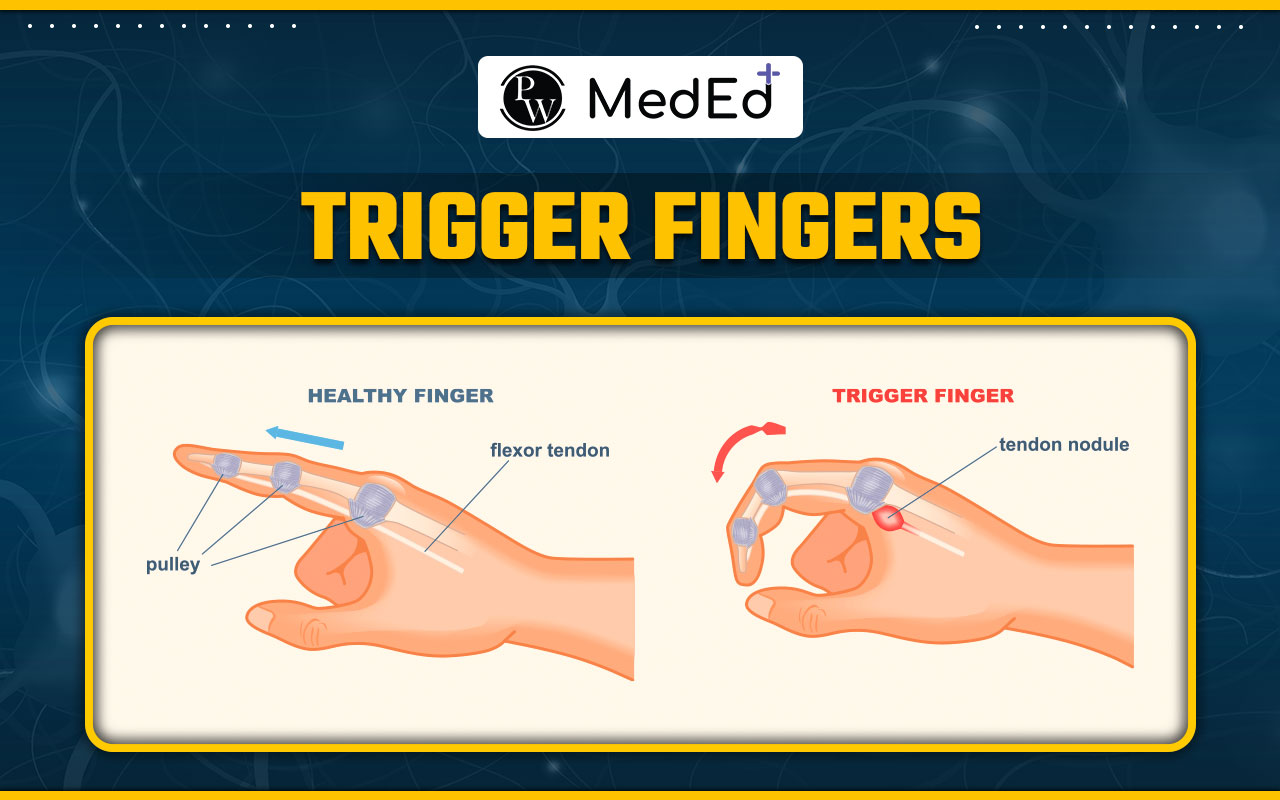 Trigger Fingers,