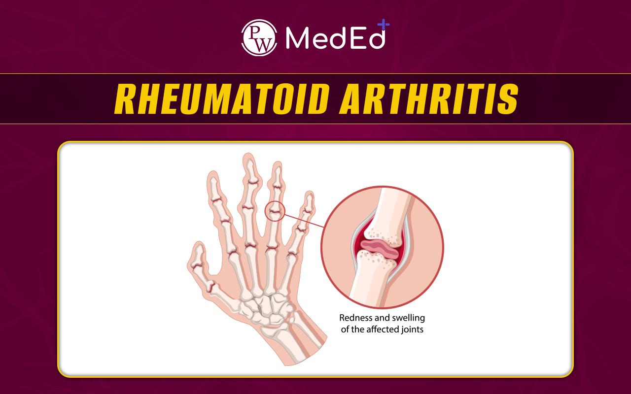 Rheumatoid Arthritis, Causes & Symptoms