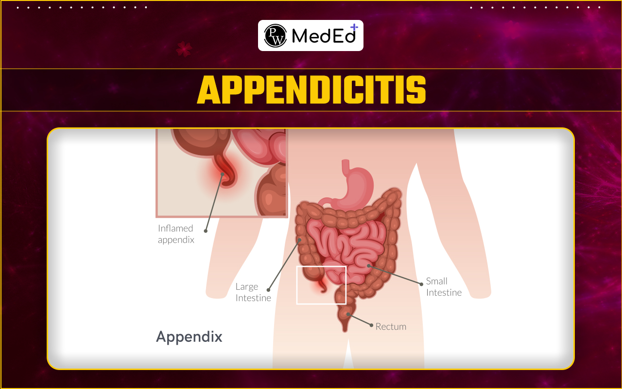 Appendicitis