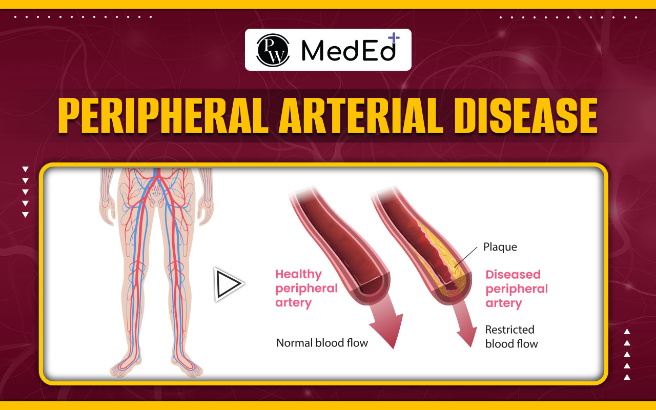 Peripheral Arterial Disease