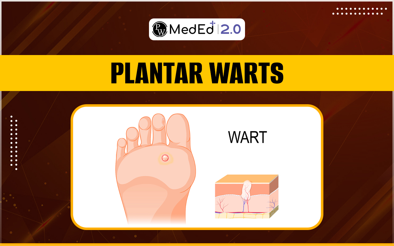 Plantar Warts Causes, Symptoms, Risk Factors, And Treatment