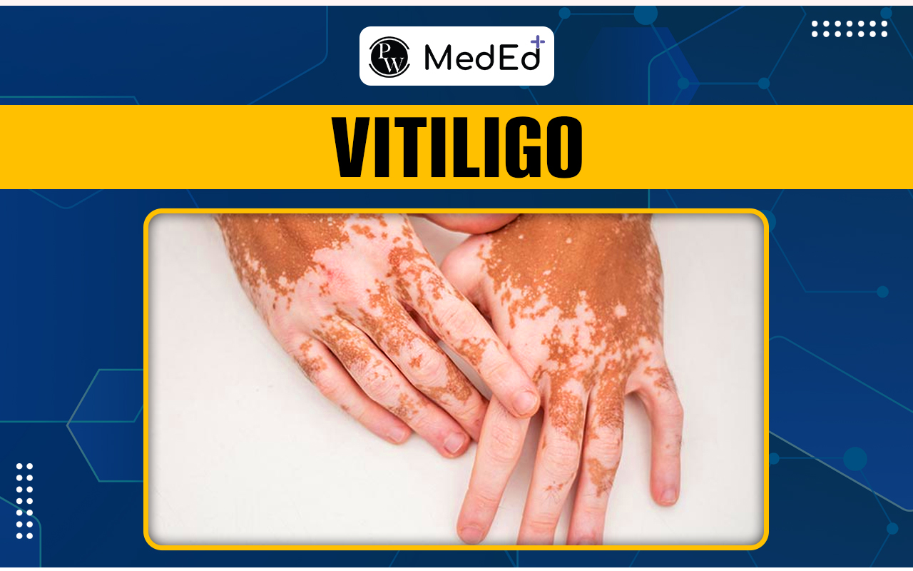 Vitiligo Causes, Symptoms, Diagnosis, Complications, and Treatment
