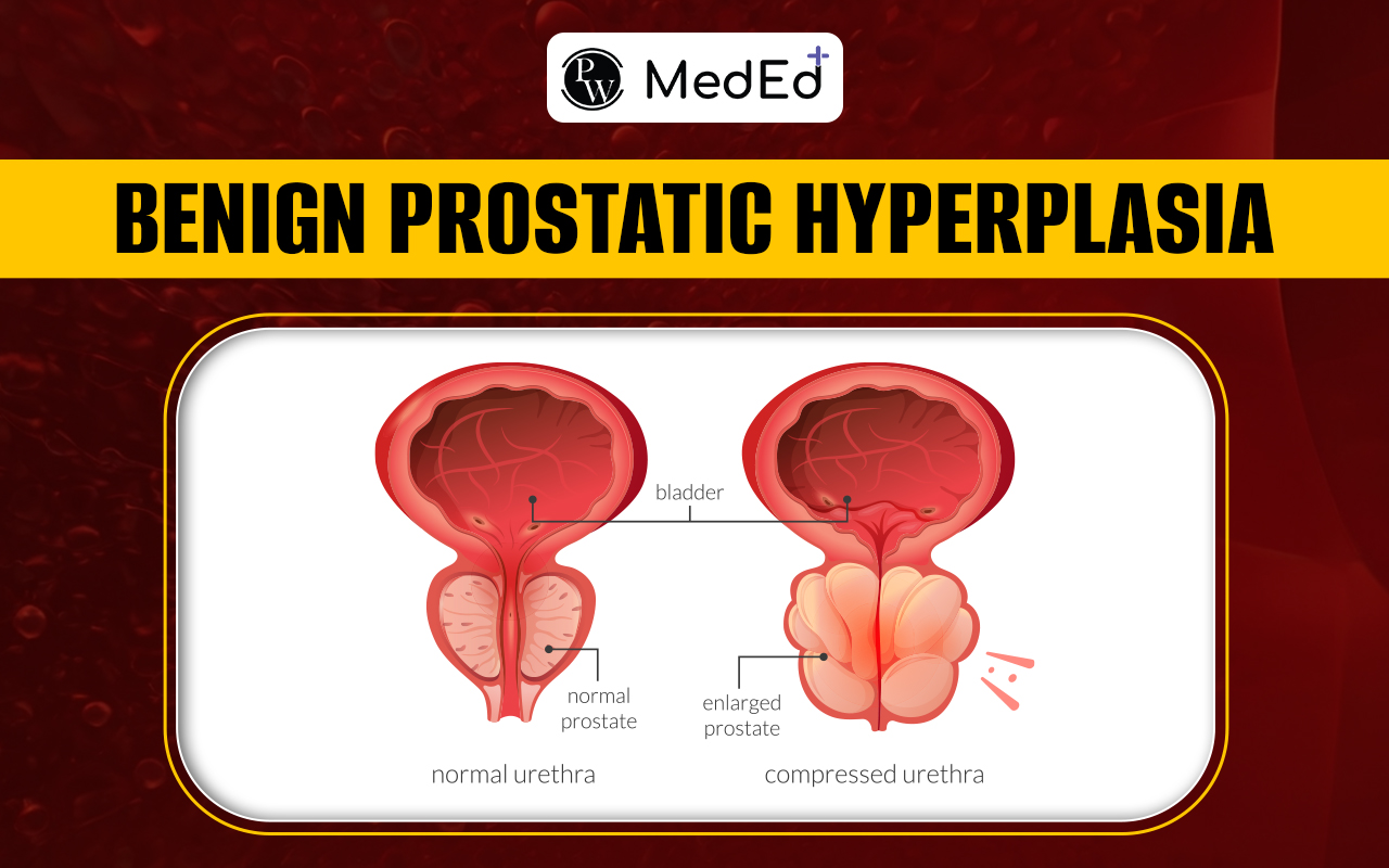 Benign Prostatic Hyperplasia