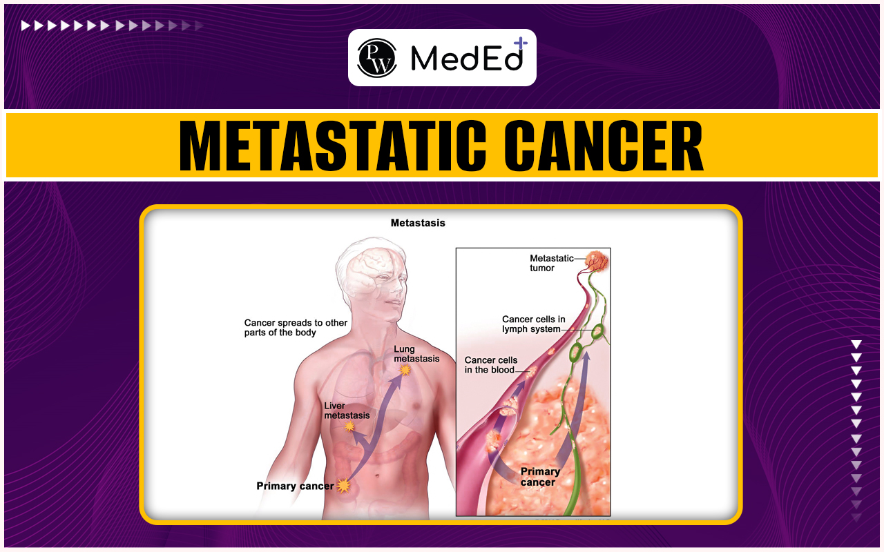 Metastatic Cancer Causes, Symptoms, Diagnosis, And Treatment
